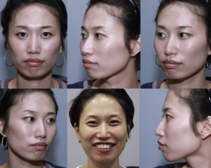 1 Facial Contouring Surgery Clinic in Korea – Seoul Cheil Plastic